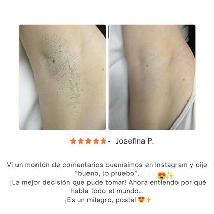Epify, Depilación Rápida, Indolora y Duradera